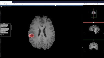 Brush-based Segmentation of a Brain Tumor in a Web Browser