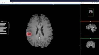 Brush-based Segmentation of a Brain Tumor in a Web Browser