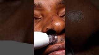T-Zone Oil & Blackhead Vacuum Reset #macroasmr #satisfying #blackheadcaique #skincare #satisfyling