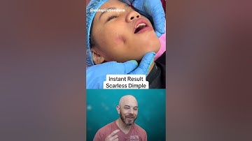 Dimple surgery...tempting or terrifying? 🤔 (credit: @skinspirationderm on TT) #reaction #dermatology