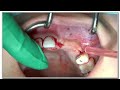 Live Surgery: Major Bone Augmentation: A Framework for Success - Dr Sascha A. Jovanovic
