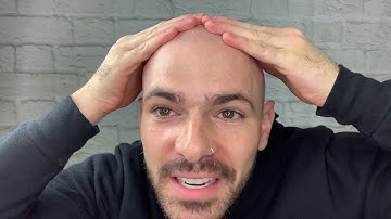 SMP Laser Removal after 10 Years!!!!!