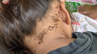 Remove thousand lice from long hair - Getting out all hundred lice from brown hair