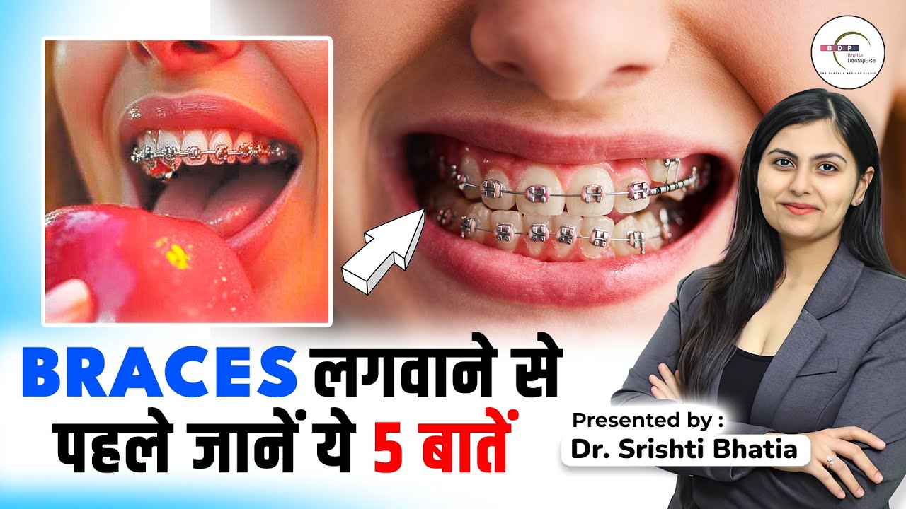 BRACES लगवाने से पहले जानें ये 5 बातें: Dr.Srishti Bhatia 