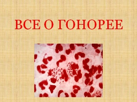 Гонорея. Гонорея у мужчин. Гонорея у женщин. Гонорея симптомы.