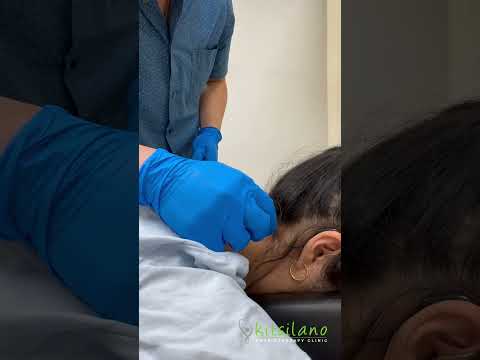 Acupuncture