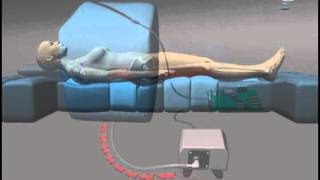 Pressure sore prevention bed