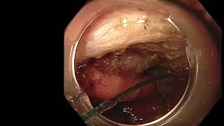 Suturing a wide post-ESD gastric defect with SutuArt. @EndoscopyVideo