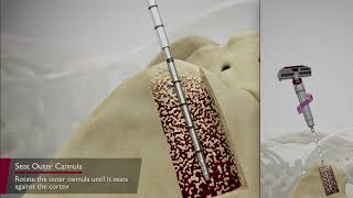Marrow Cellution Bone Marrow Aspiration By Cervos Medical