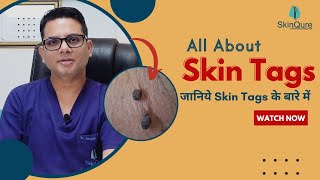 Know all about Skin Tags | Skin Tags Treatment in Delhi | SkinQure screenshot 5