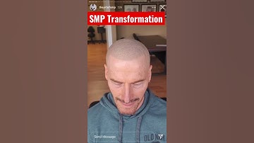 Scalp Micropigmentation Before and After Transformation