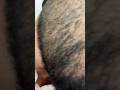 #ingrownhair #satisfying #massagespa #asmrmassage #viralvideo
