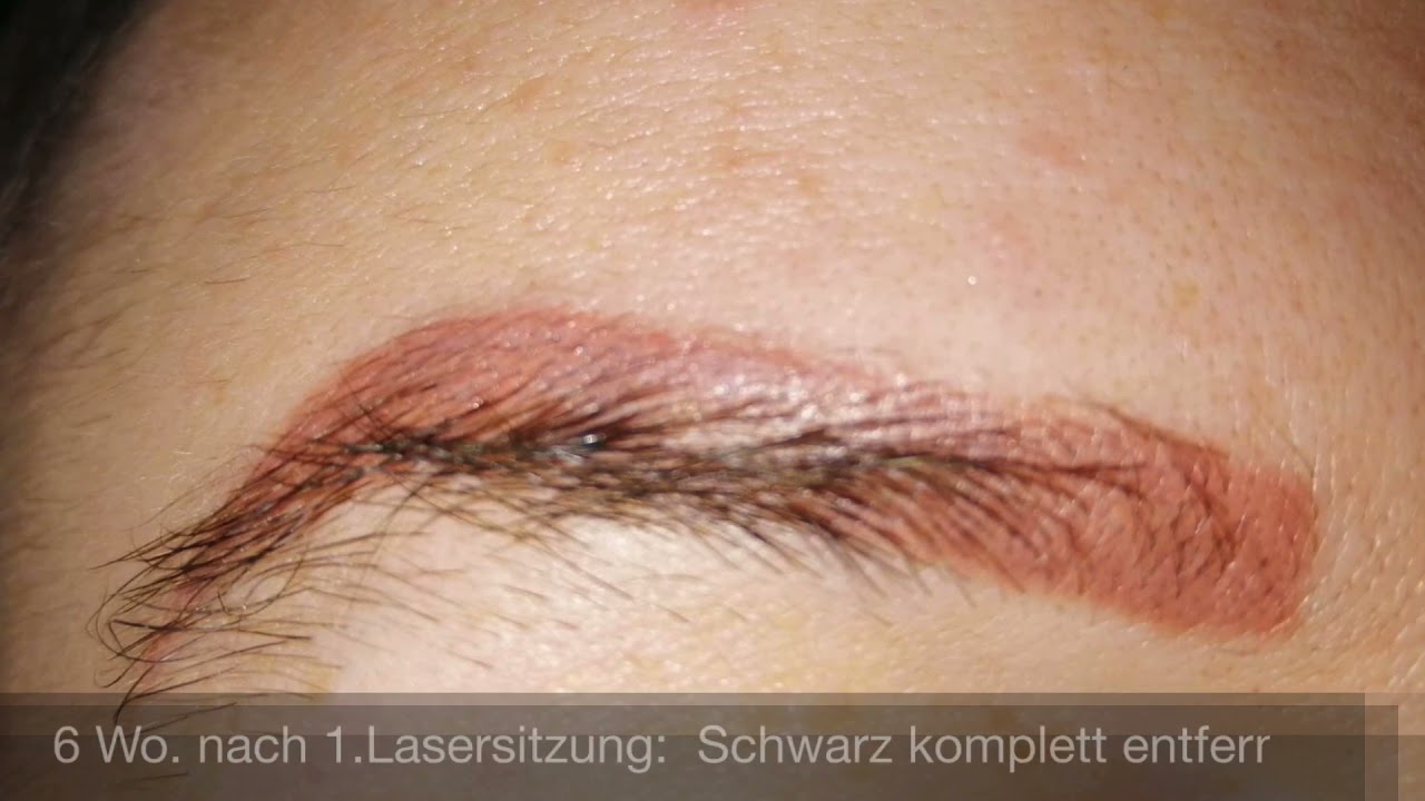 Entfernung von Permanent Make-Up im Medicorium Dr. Greiner-Krüger (Oberursel)