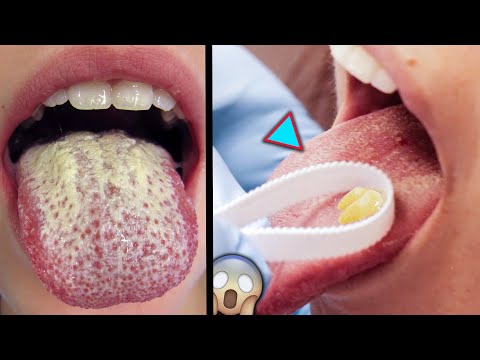 Video Thứ Bám Trên Lưỡi là gì ? | Cấu Tạo của Lưỡi. - youtube