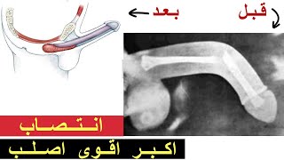 حشرة بالسعودية والكويت تساعد بتكبير القضيب