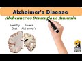 Alzheimer's Disease, difference between Alzheimer, dementia and amnesia