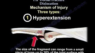 PIP Dorsal Fracture Dislocation - Everything You Need To Know - Dr. Nabil Ebraheim