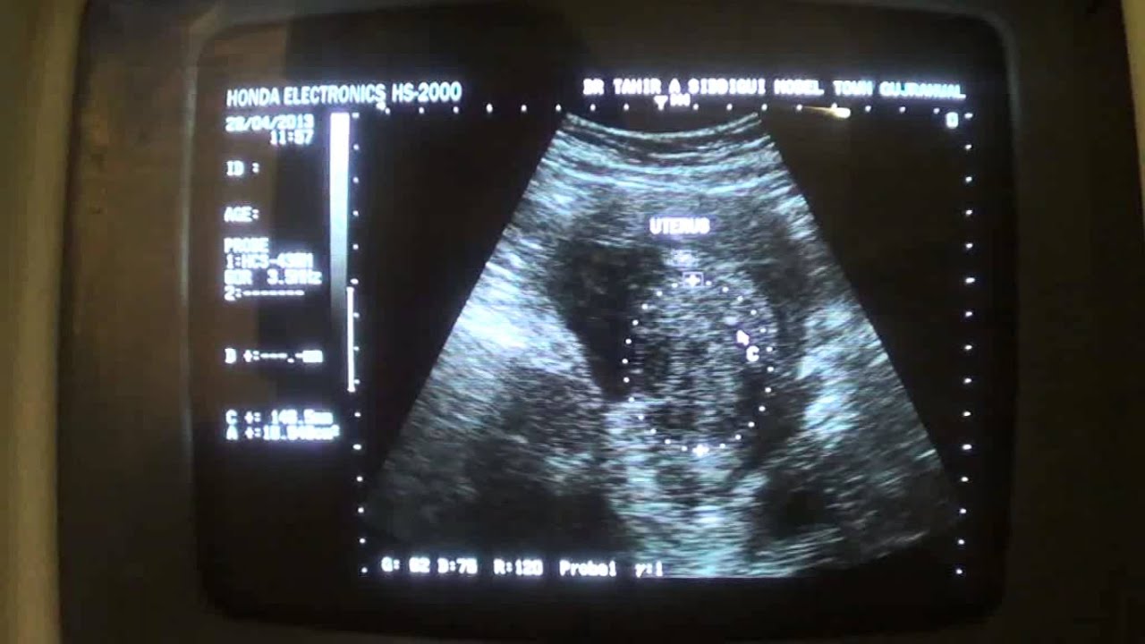 UTERINE FIBROID in postmenopausal age YouTube