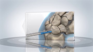 Acumed: Acutrak2 Benefits and Features