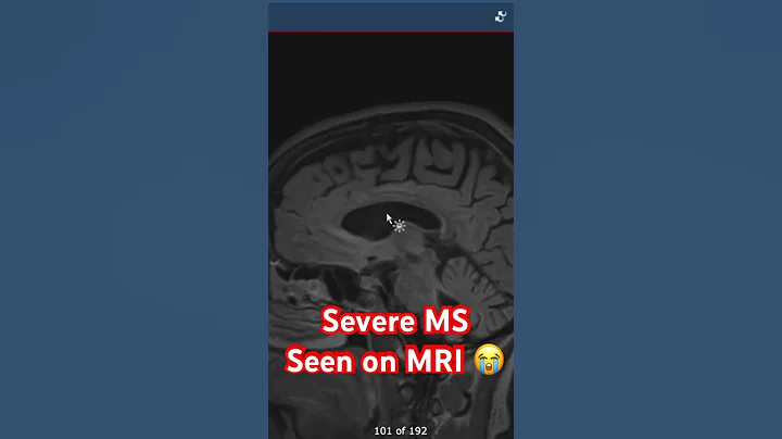 Severe MS seen on MRI 😭
