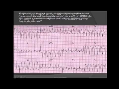 ეკგ / უცნობი ეტიოლოგიის ფართოკომპლექსებიანი ტაქიკარდია / მიოკარდიუმის წინა კედლის მწვავე ინფარქტი