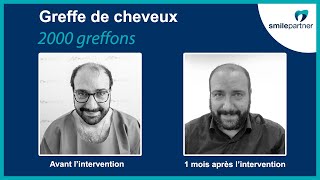 Greffe de cheveux en Hongrie : "Je suis ravi de voir tous ces petits cheveux pousser !"
