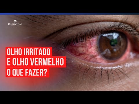 OLHO IRRITADO e VERMELHO - O que fazer? Como tratar?