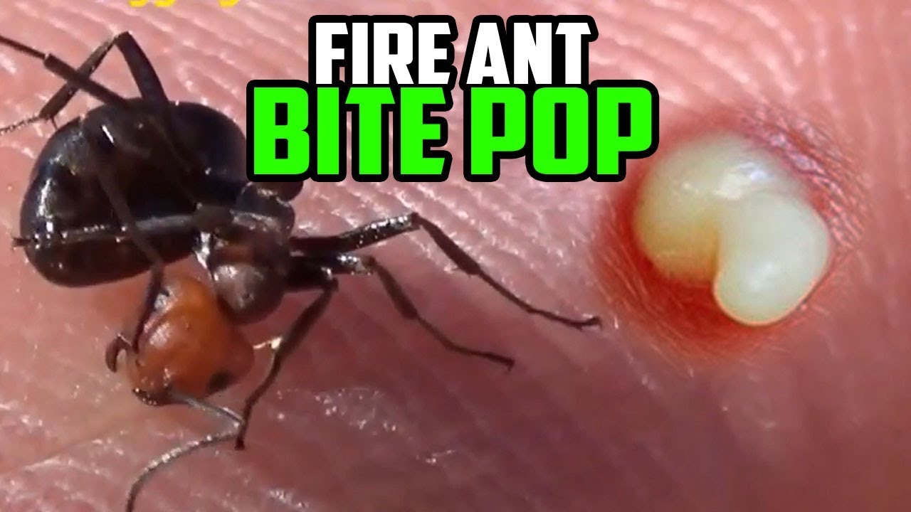 Question Why Do Fire Ant Bites Turn Into Pimples Black Lights