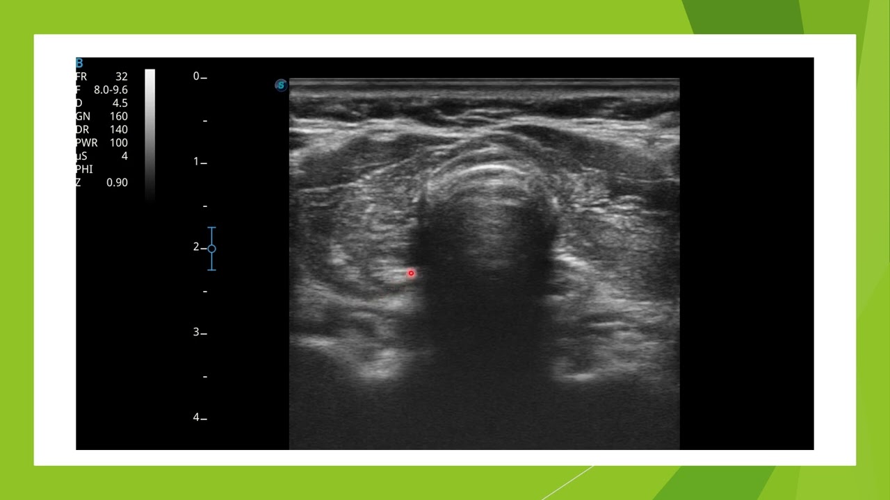 Echographie d'une Thyroidite de Hashimoto