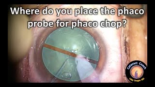 Where do you place the probe to facilitate phaco chop cataract surgery?