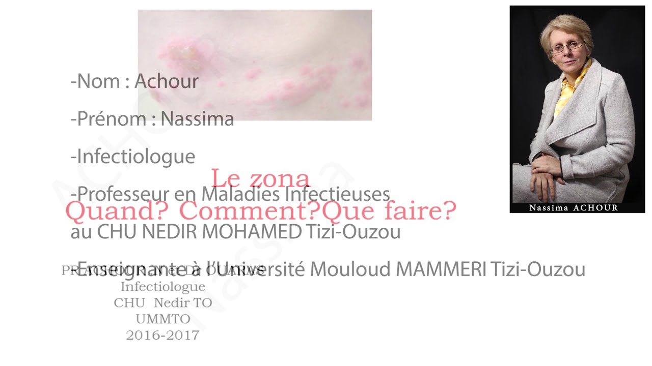 Présentation de la maladie du ZONA Pr Achour YouTube