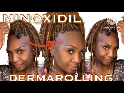 NO EDGES? BALDING? HAIRLOSS? #minoxidil #dermaroller #alopecia #hairloss #hair #edges  #rogaine