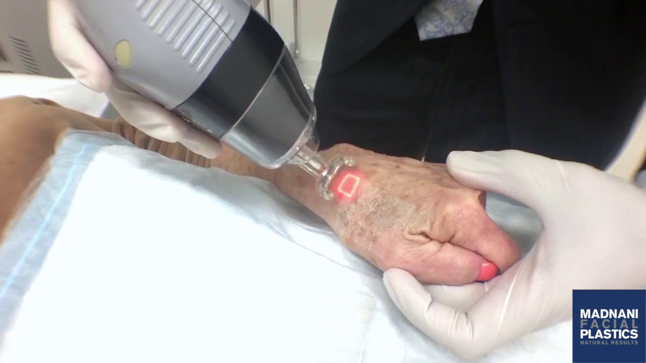C02 Laser Hand Rejuvenation YouTube
