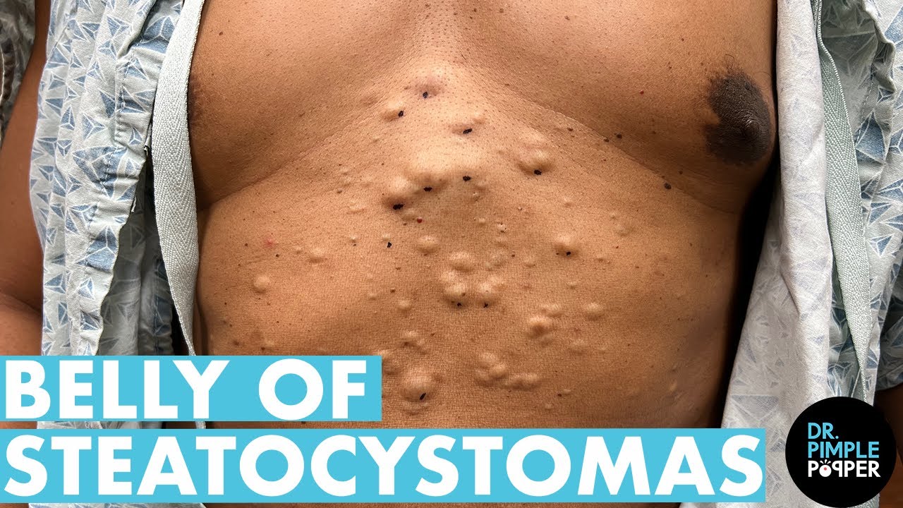  A Belly Full Of Steatocystomas! Dr Pimple Popper Mines a Patient's Stomach - Part 1