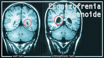 O que fazer em um surto de esquizofrenia?