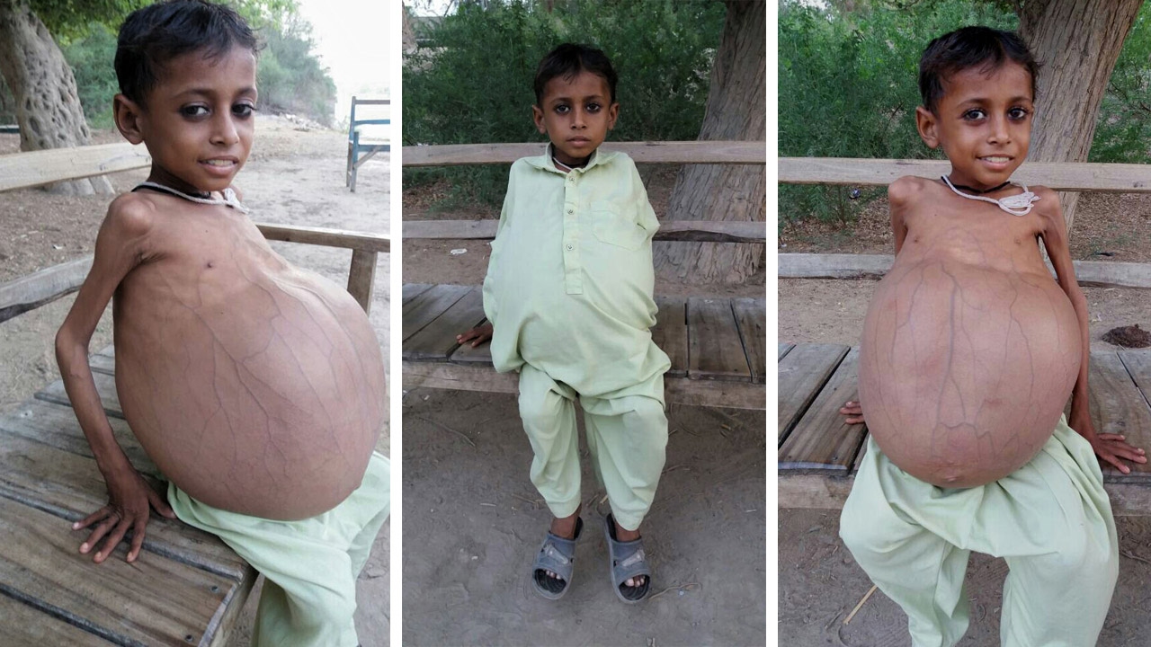 Nine Year Old's Stomach Size Of A Beach Ball YouTube