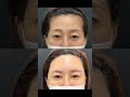 🔥最強の若返り手術＝眉下リフト×ベイビーおでこ脂肪注入