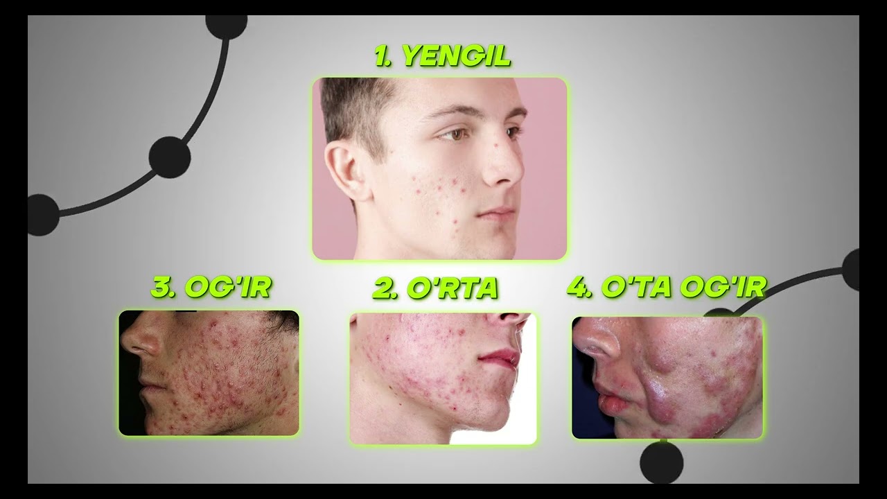 Ugri kasalligini 1 ta maz yoki dori bilan davolash mumkinmi?