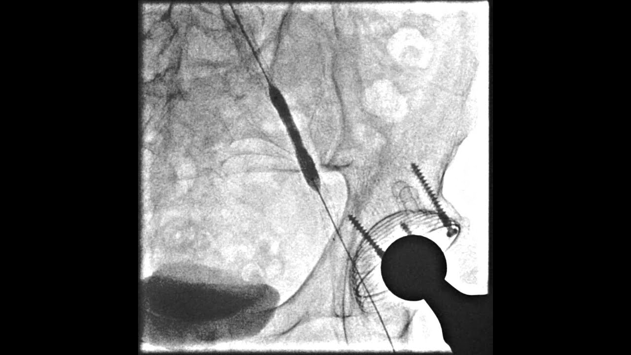 Стентирование артерий нижних конечностей - YouTube