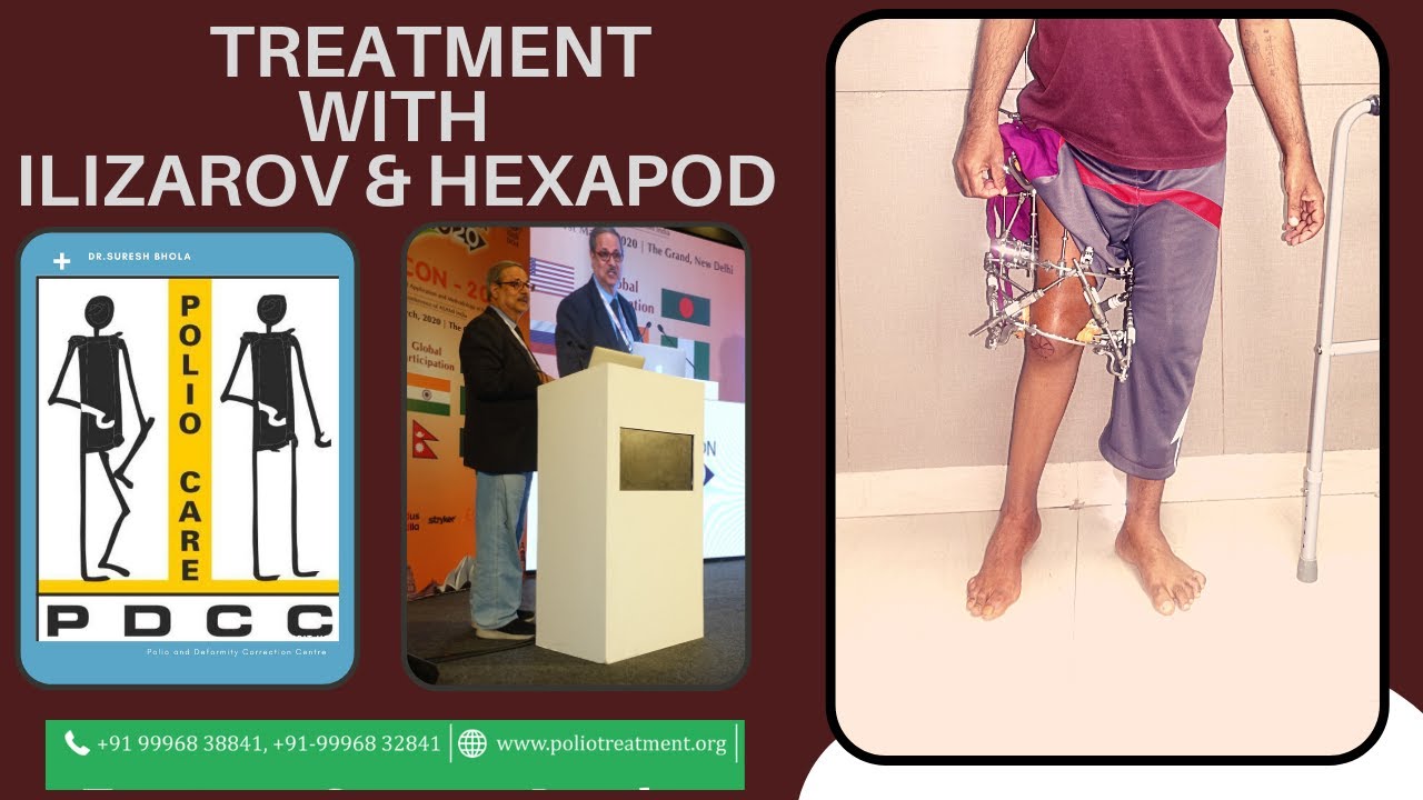 Polio treatment with Ilizarov and Hexapod, at Bhola Hospital, Kurukshetra ,Haryana, India