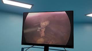 Ventral Hernia #IPOM#Step by step explanation #Resident Training #Dr.Saurabh Dixit