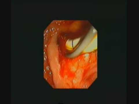 ERCP - Sphincterotomy for CBD stone - Bleeding sphincterotomy - STEFANOS DOKAS - The ERCP Channel