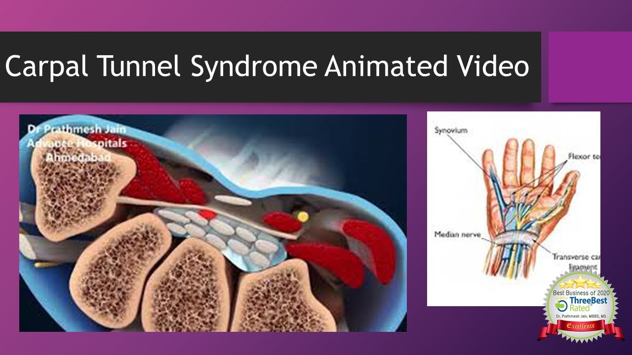 Carpal Tunnel Syndrome Animated Video in English - YouTube