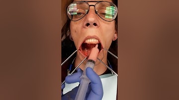 Mandibular Pick Up With Smart Denture Conversions by Smart On X