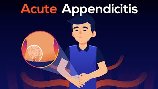 What is Appendicitis? A real case of Burst Appendix.
