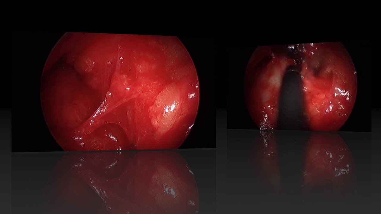 Supervideomediastinoscopia (VAMLA + Extendida) vats killer