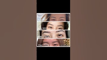 Eyebrow laser tattoo removal. First session. #microblading #lasertattooremoval #eyebrows