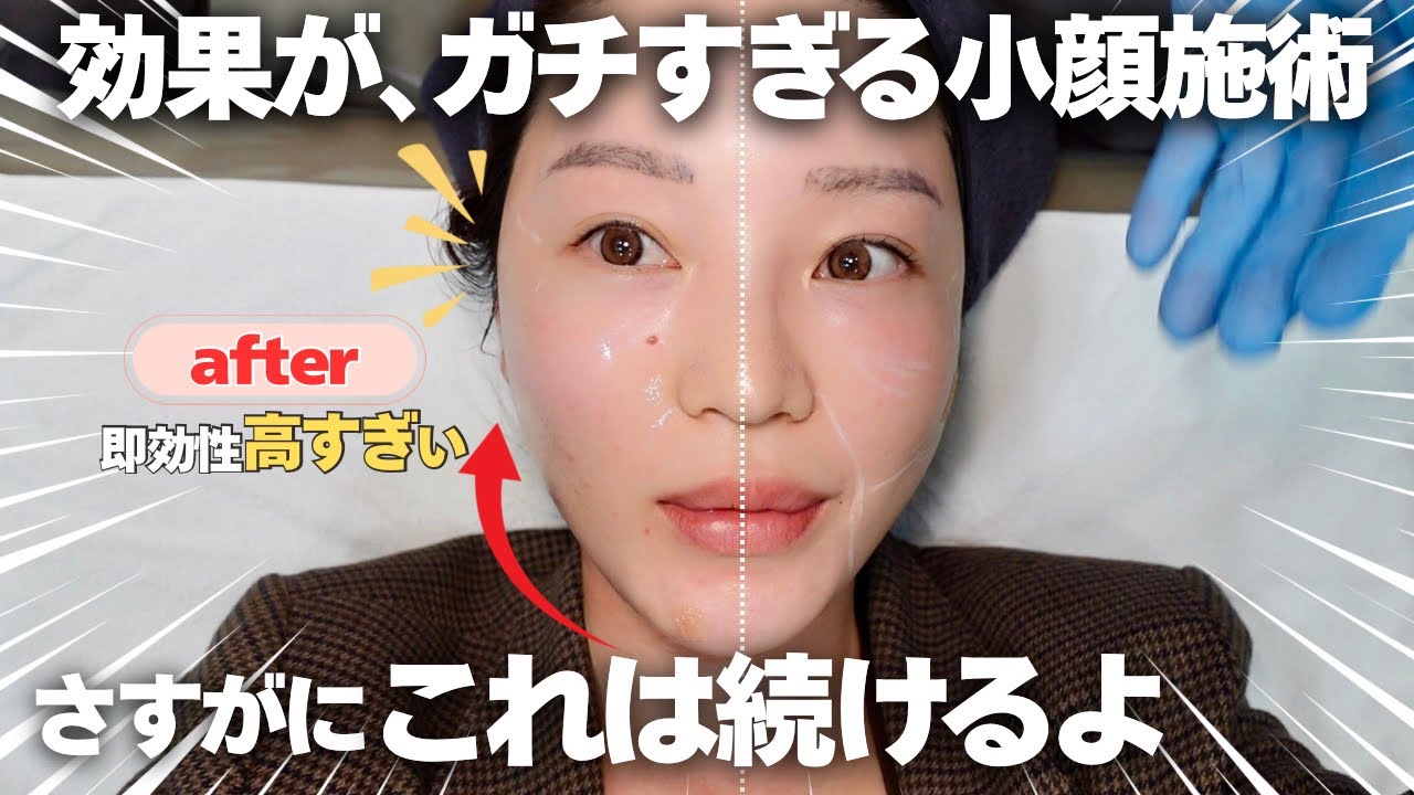 【小顔革命】今年史上最強に驚愕の"引き締め施術"脂肪溶解×タイトニング　一体これは何が起きた⁉︎