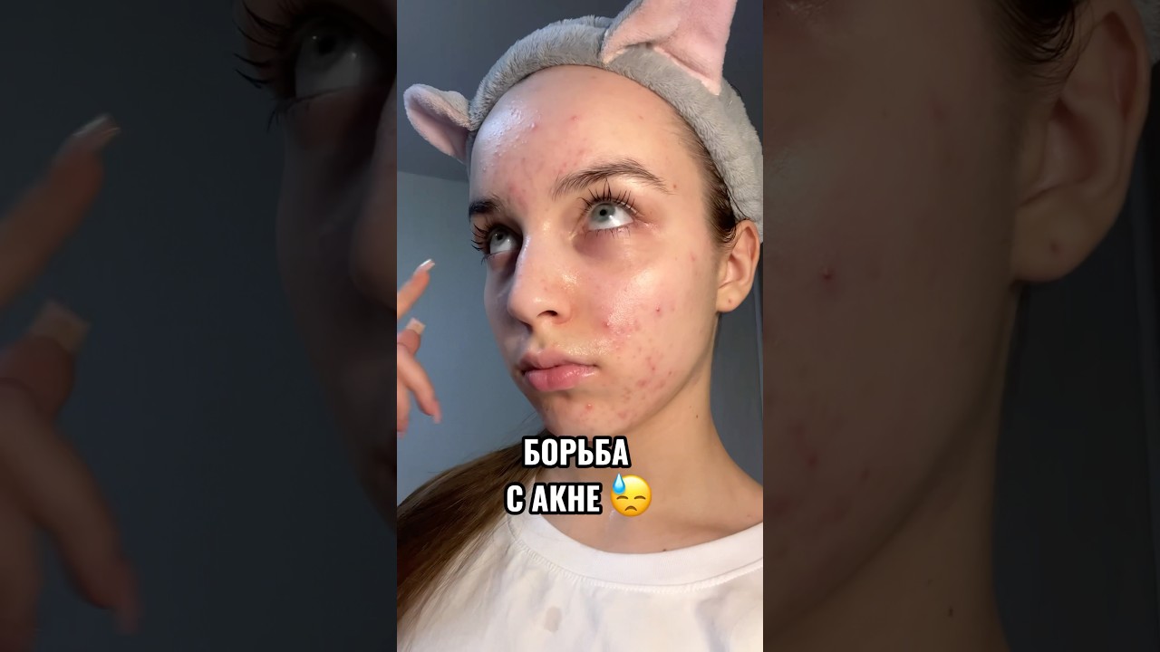 ЛЕЧУ АКНЕ 😓 уход за кожей 💔 
