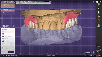Exocad Flexible Denture Design For Upper Arch (6 Teeth)